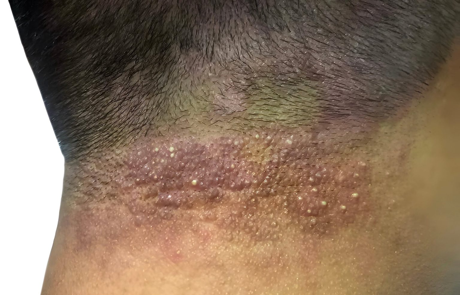 Hair loss folliculitus treatment